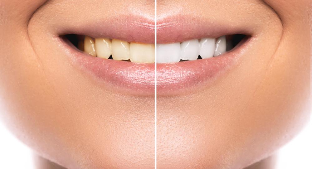Best teeth whitening