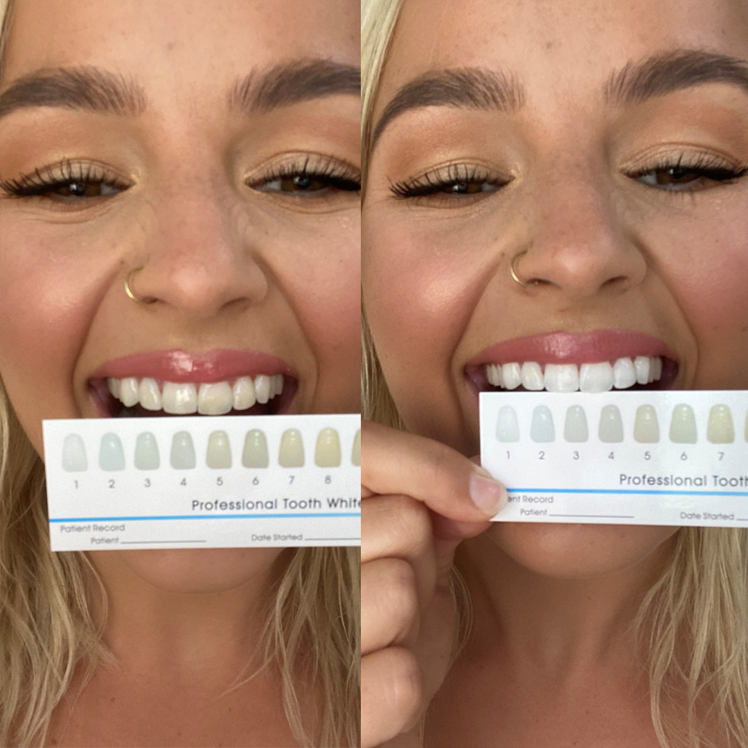 SmilePro Advanced Whitening Set